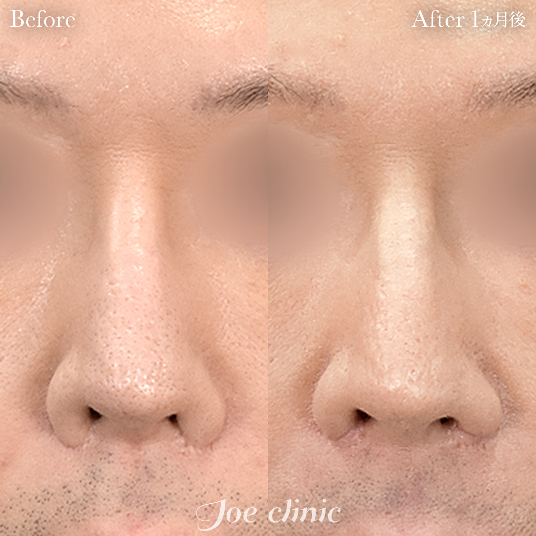 【50代男性・他院修正】鼻孔拡大術＋鼻孔縁挙上術｜1ヵ月後