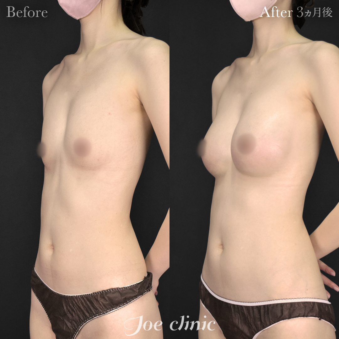 【30代女性】シリコンバッグ豊胸モティバ2(290cc×左右)|3ヵ月後