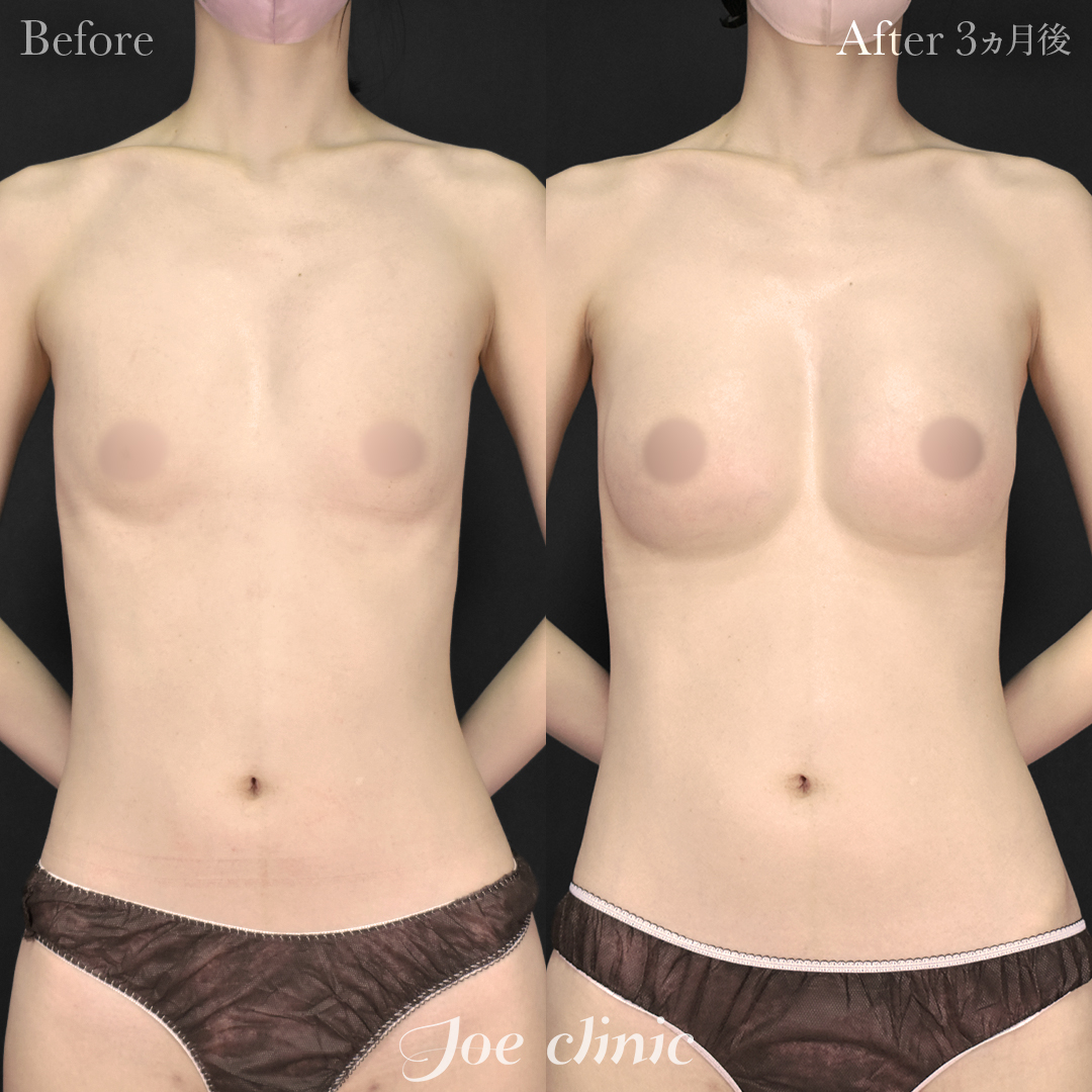 【30代女性】シリコンバッグ豊胸モティバ2(290cc×左右)|3ヵ月後