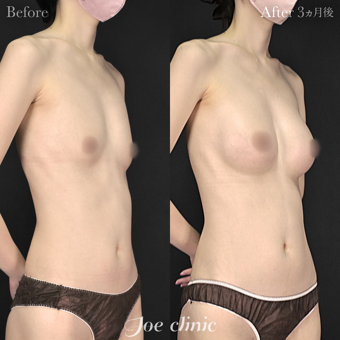 【30代女性】シリコンバッグ豊胸モティバ2(290cc×左右)|3ヵ月後