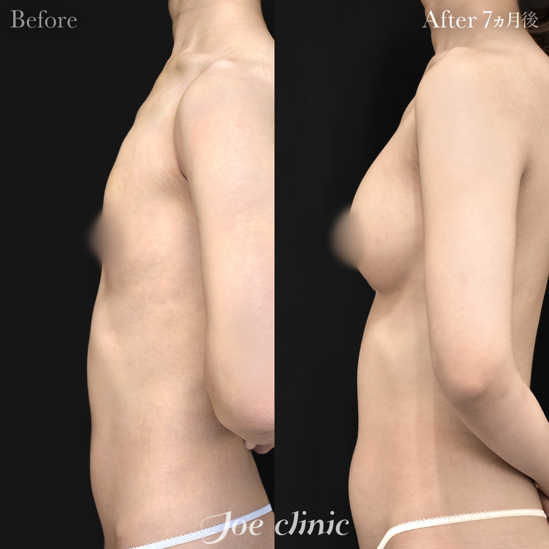 【30代女性】シリコンバッグ豊胸モティバ2(275cc×左右)|7ヵ月後