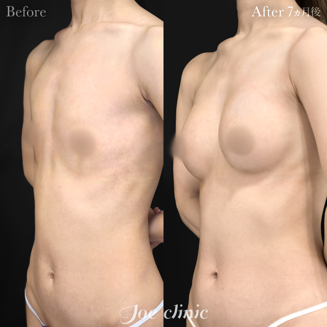 【30代女性】シリコンバッグ豊胸モティバ2(275cc×左右)|7ヵ月後