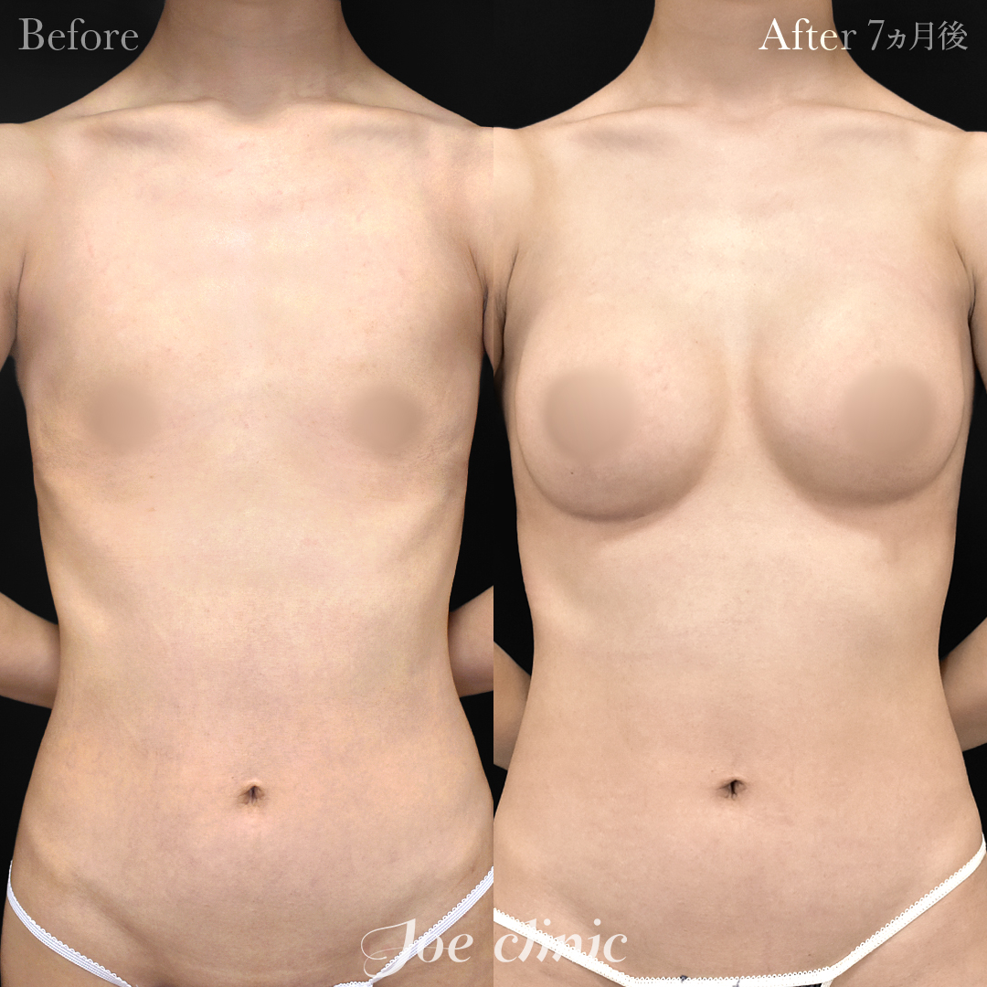 【30代女性】シリコンバッグ豊胸モティバ2(275cc×左右)|7ヵ月後