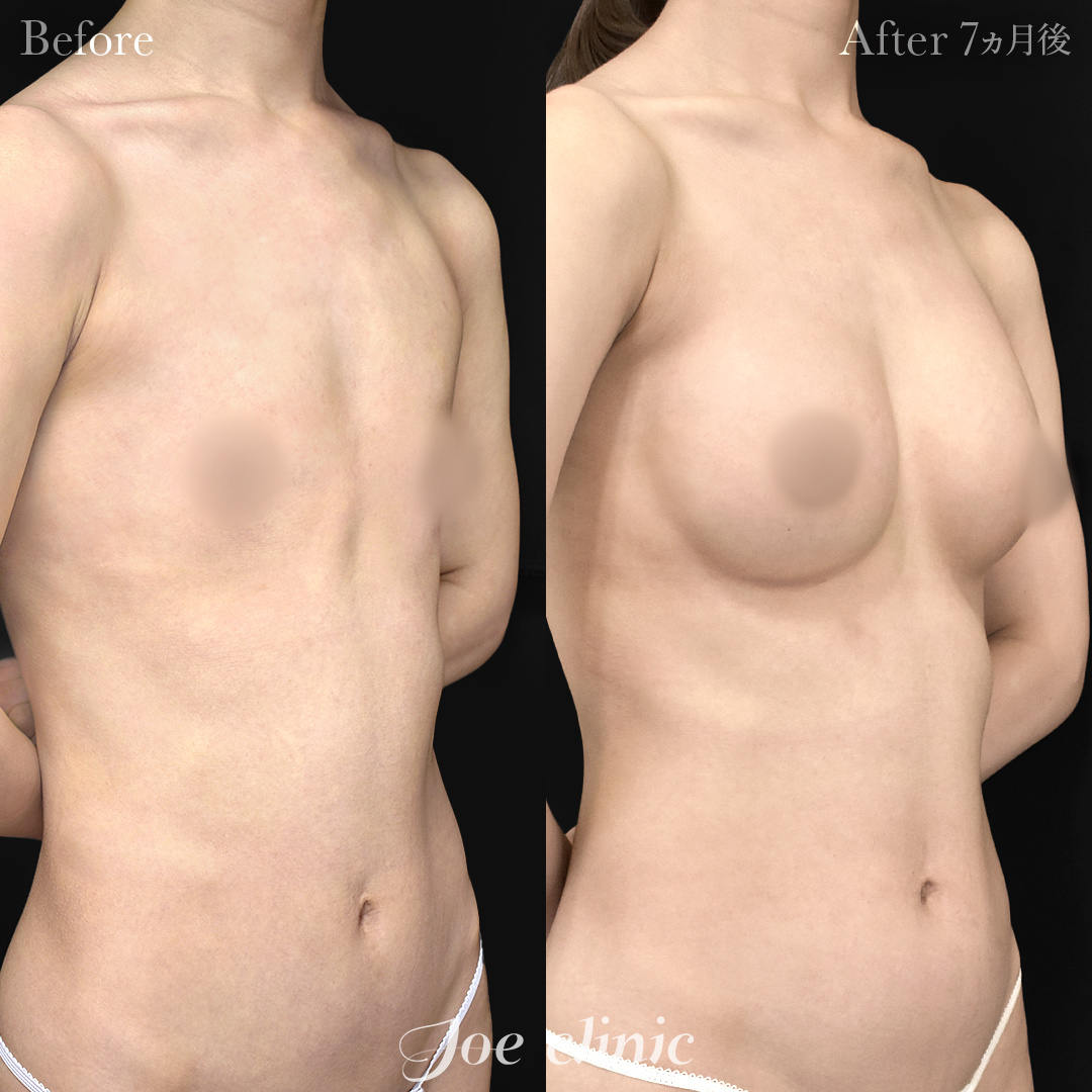 【30代女性】シリコンバッグ豊胸モティバ2(275cc×左右)|7ヵ月後