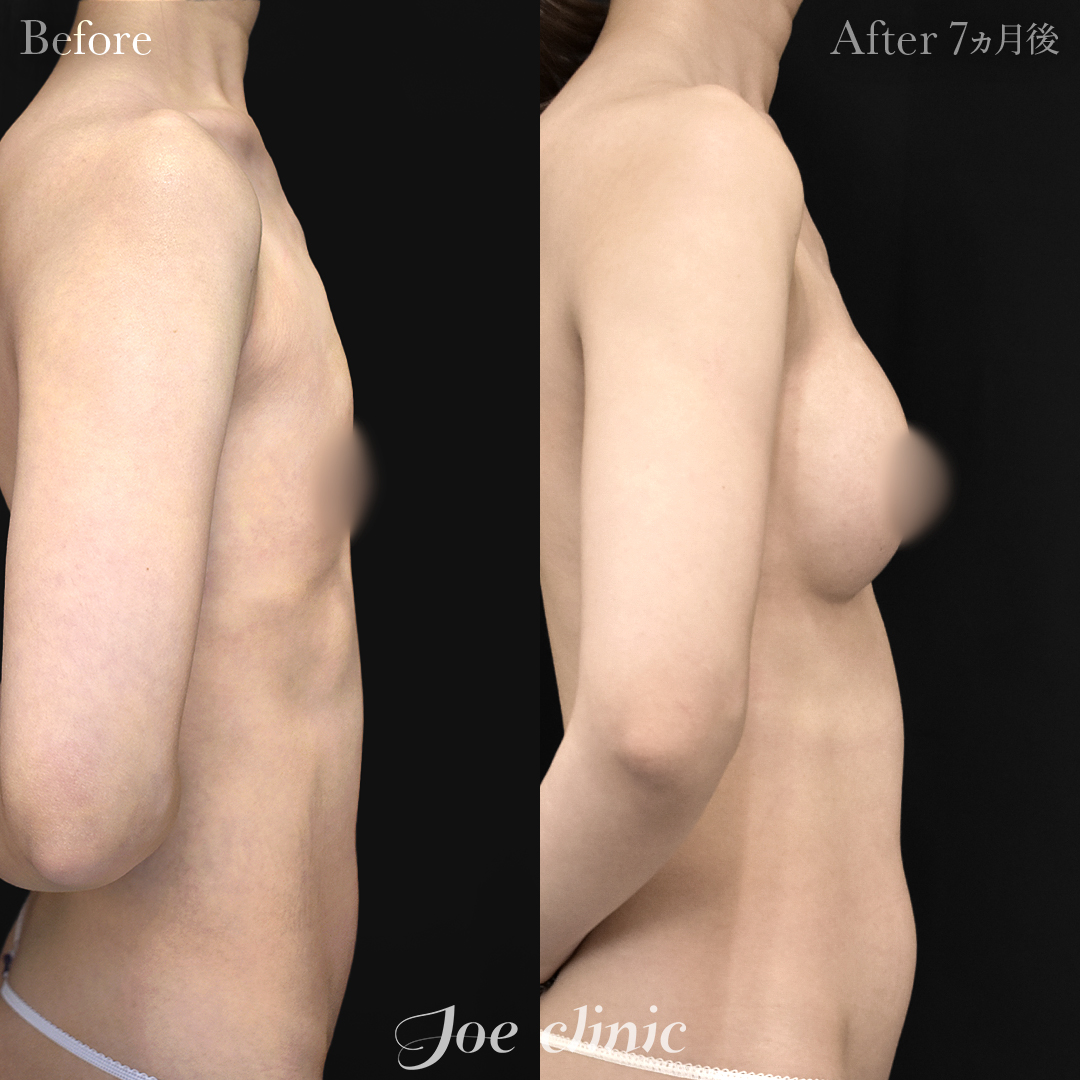 【30代女性】シリコンバッグ豊胸モティバ2(275cc×左右)|7ヵ月後