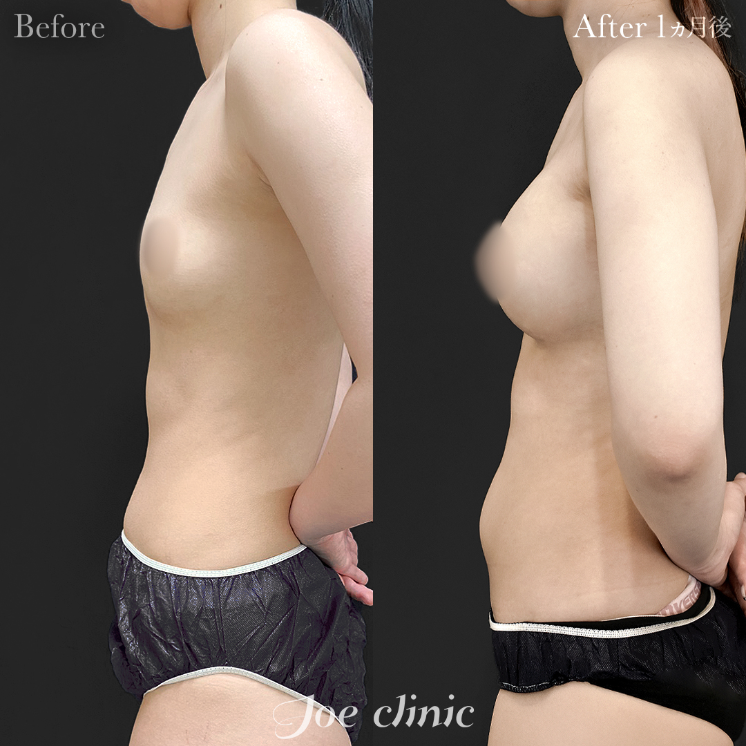 【20代女性】シリコンバッグ豊胸モティバ2(335cc×左右)|1ヵ月後