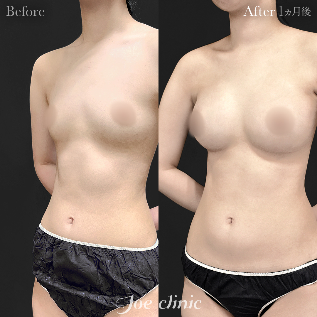 【20代女性】シリコンバッグ豊胸モティバ2(335cc×左右)|1ヵ月後