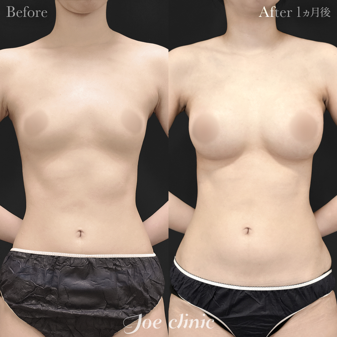 【20代女性】シリコンバッグ豊胸モティバ2(335cc×左右)|1ヵ月後