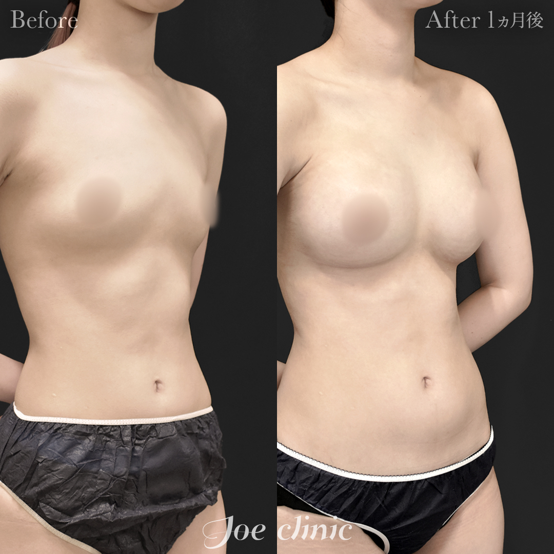 【20代女性】シリコンバッグ豊胸モティバ2(335cc×左右)|1ヵ月後