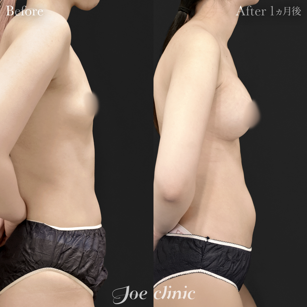 【20代女性】シリコンバッグ豊胸モティバ2(335cc×左右)|1ヵ月後