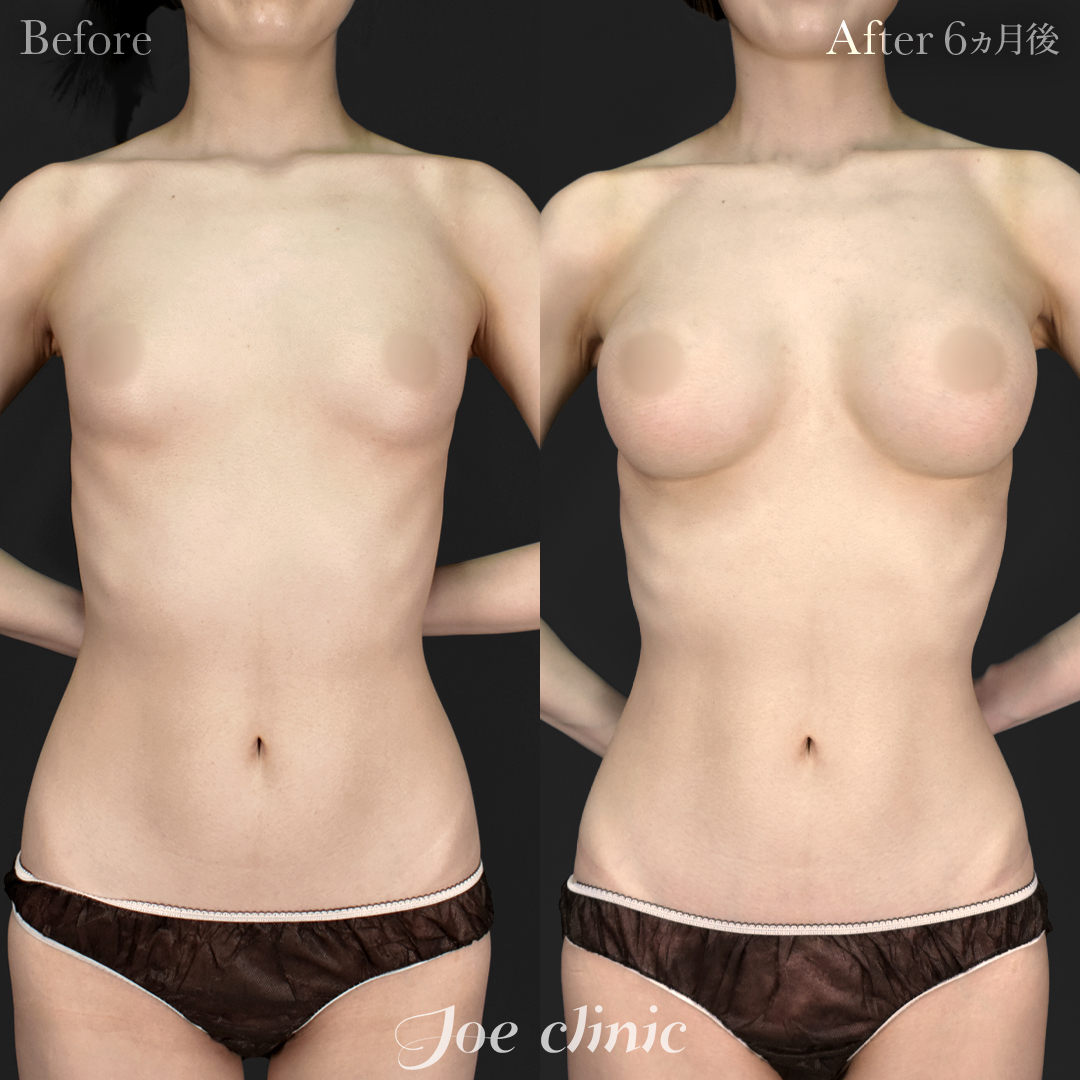 【20代女性】シリコンバッグ豊胸モティバ2(330cc×左右)+脂肪吸引(二の腕・肩)|6ヵ月後