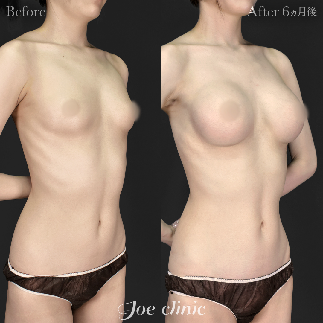【20代女性】シリコンバッグ豊胸モティバ2(330cc×左右)+脂肪吸引(二の腕・肩)|6ヵ月後