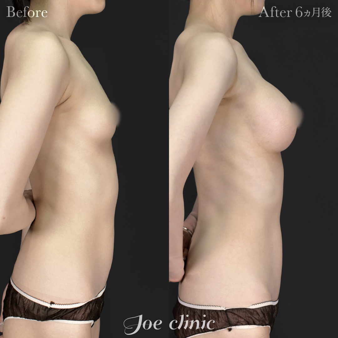 【20代女性】シリコンバッグ豊胸モティバ2(330cc×左右)+脂肪吸引(二の腕・肩)|6ヵ月後