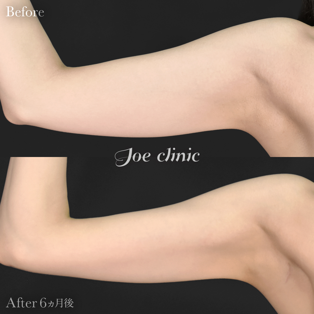 【20代女性】シリコンバッグ豊胸モティバ2(330cc×左右)+脂肪吸引(二の腕・肩)|6ヵ月後