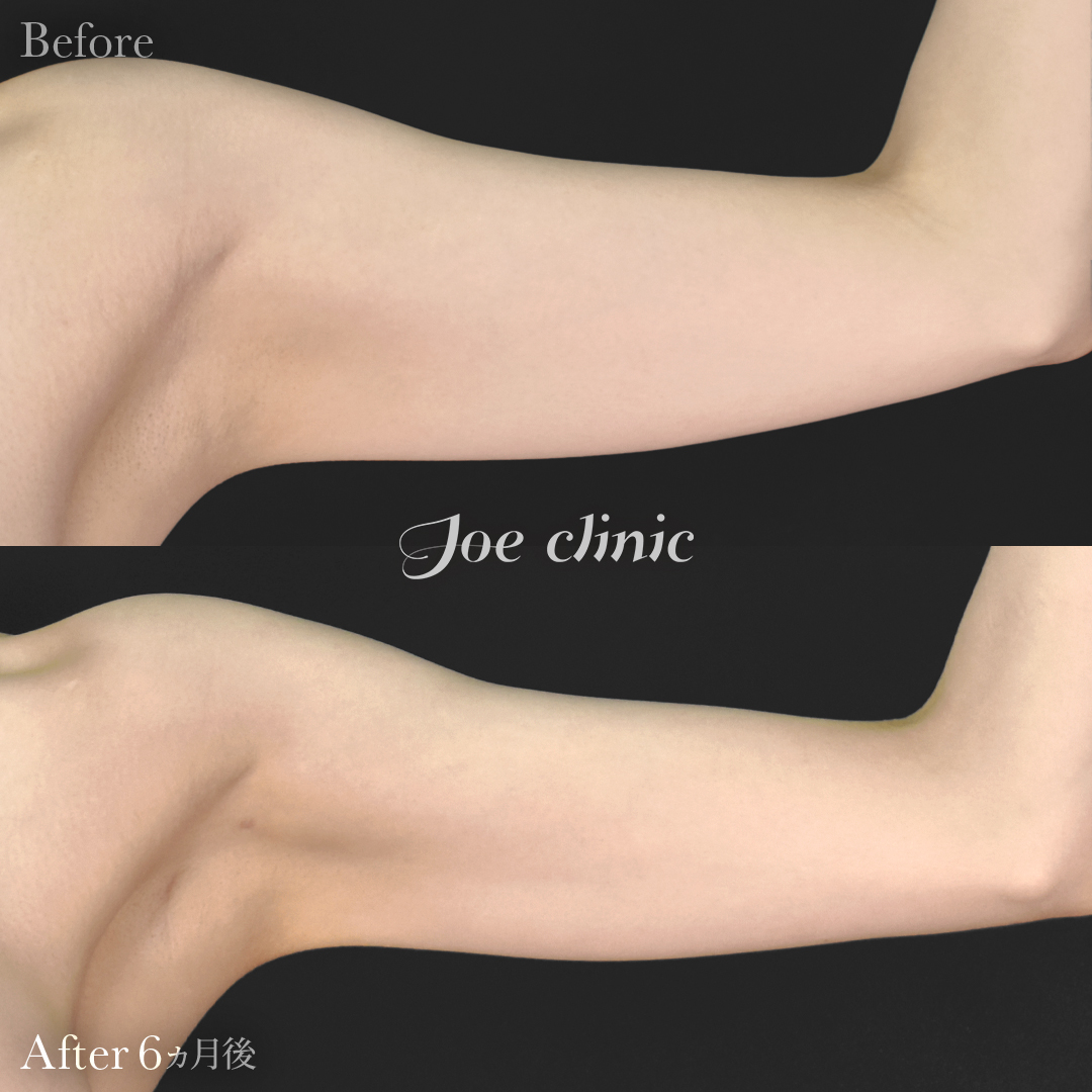 【20代女性】シリコンバッグ豊胸モティバ2(330cc×左右)+脂肪吸引(二の腕・肩)|6ヵ月後