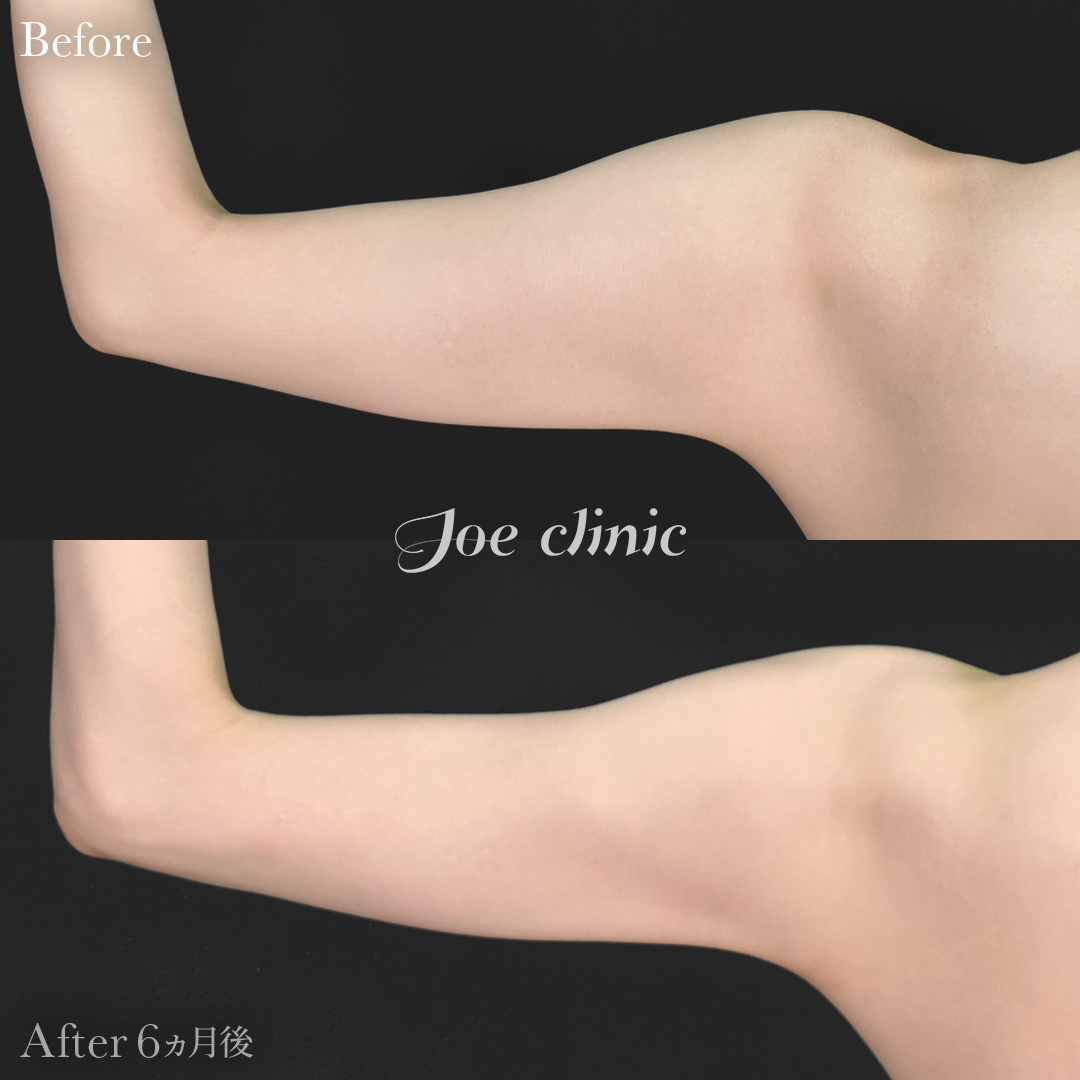 【20代女性】シリコンバッグ豊胸モティバ2(330cc×左右)+脂肪吸引(二の腕・肩)|6ヵ月後