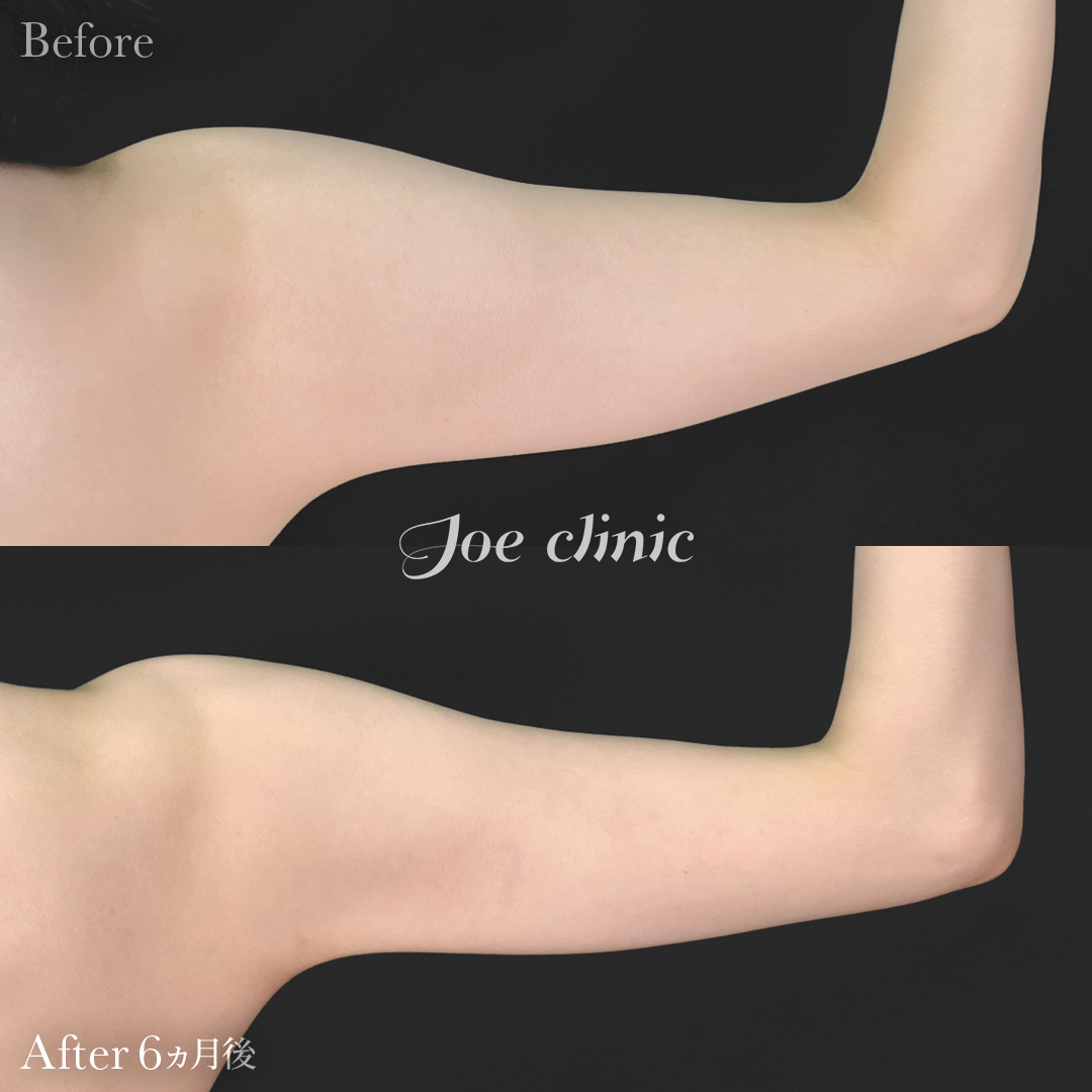 【20代女性】シリコンバッグ豊胸モティバ2(330cc×左右)+脂肪吸引(二の腕・肩)|6ヵ月後