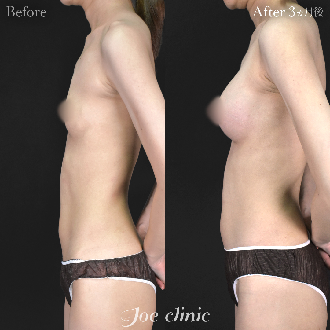 【30代女性】シリコンバッグ豊胸モティバ2(250cc×左右)|3ヵ月後