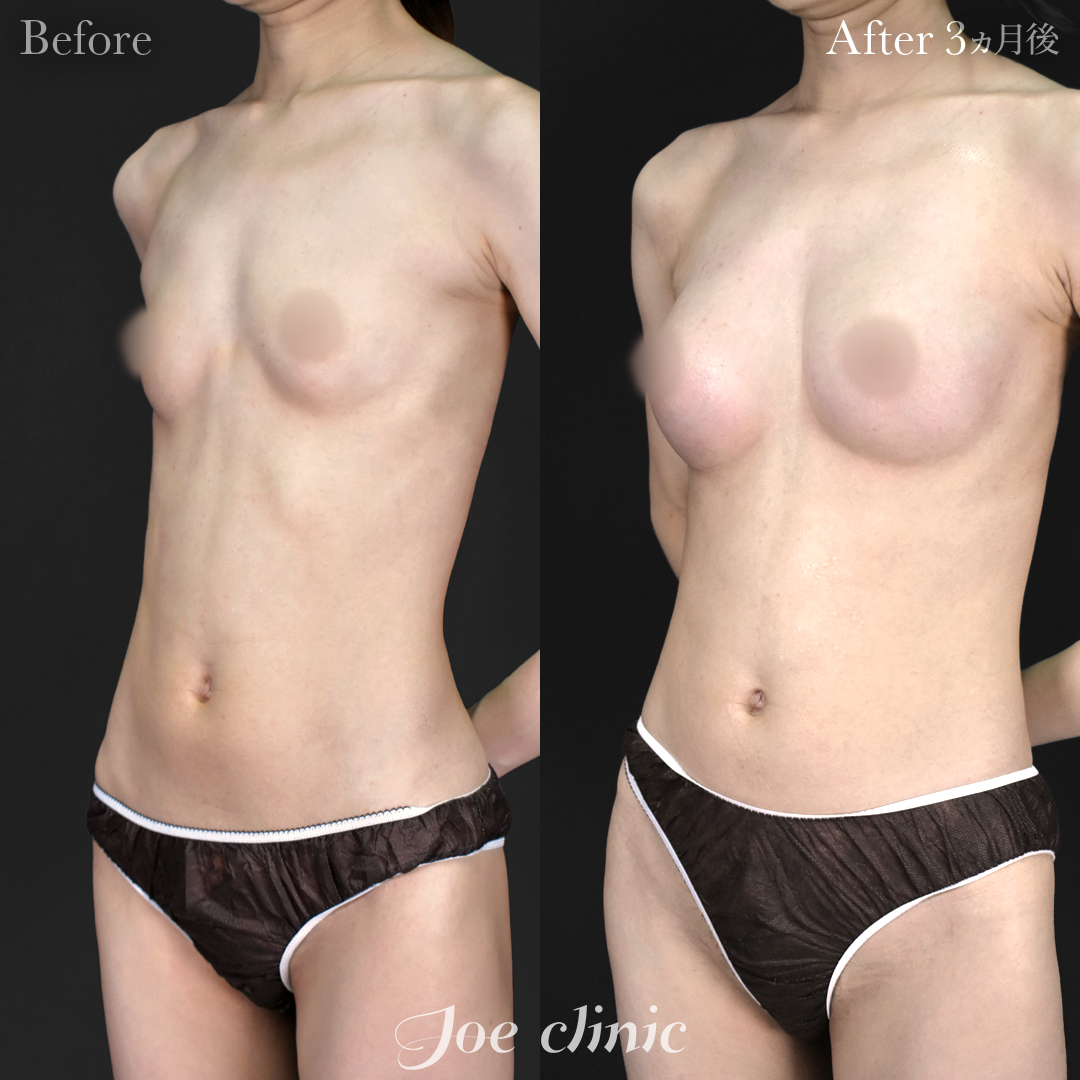 【30代女性】シリコンバッグ豊胸モティバ2(250cc×左右)|3ヵ月後