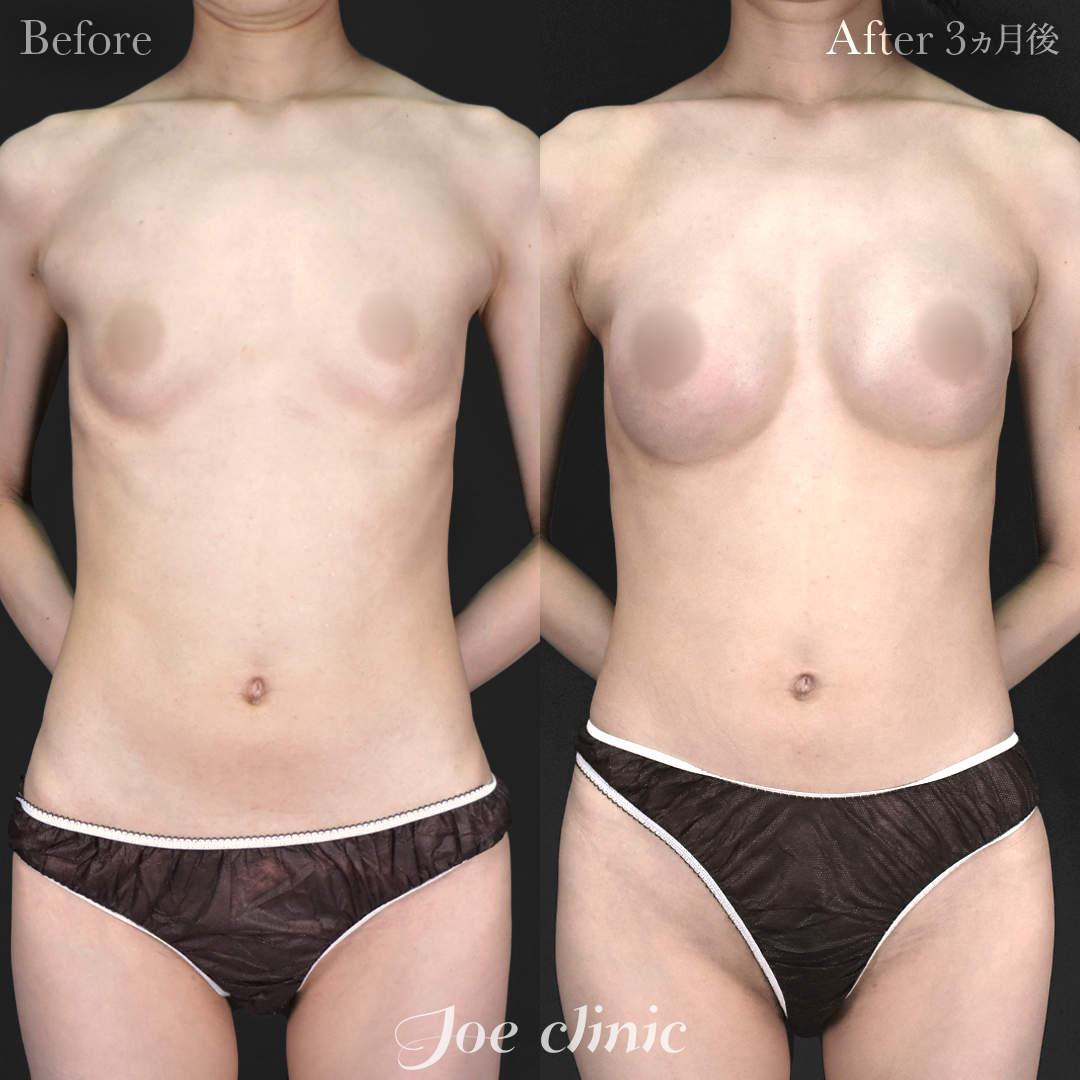 【30代女性】シリコンバッグ豊胸モティバ2(250cc×左右)|3ヵ月後