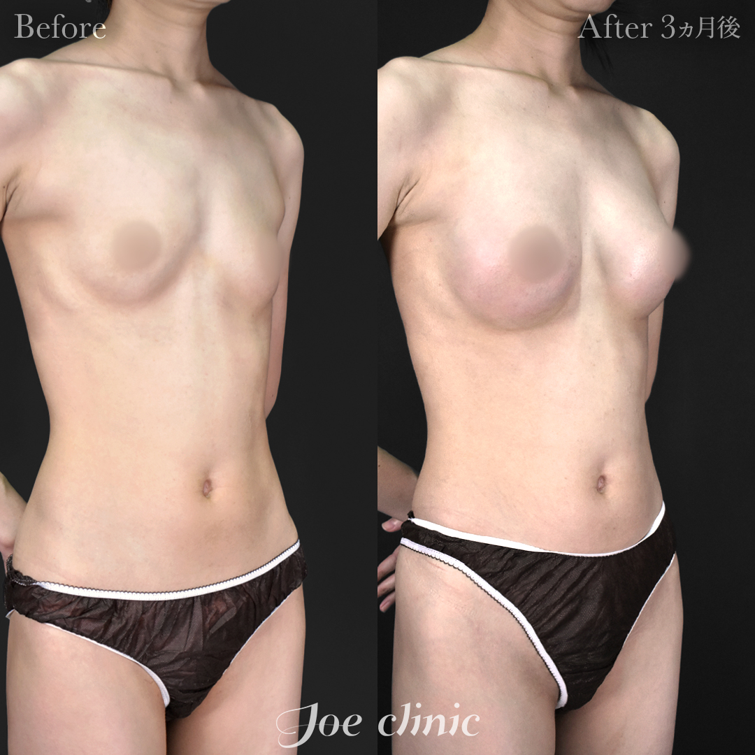 【30代女性】シリコンバッグ豊胸モティバ2(250cc×左右)|3ヵ月後