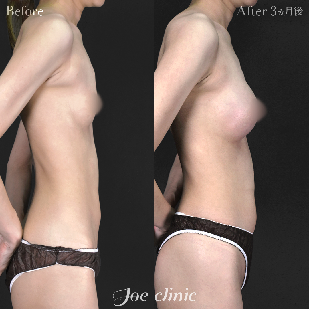 【30代女性】シリコンバッグ豊胸モティバ2(250cc×左右)|3ヵ月後