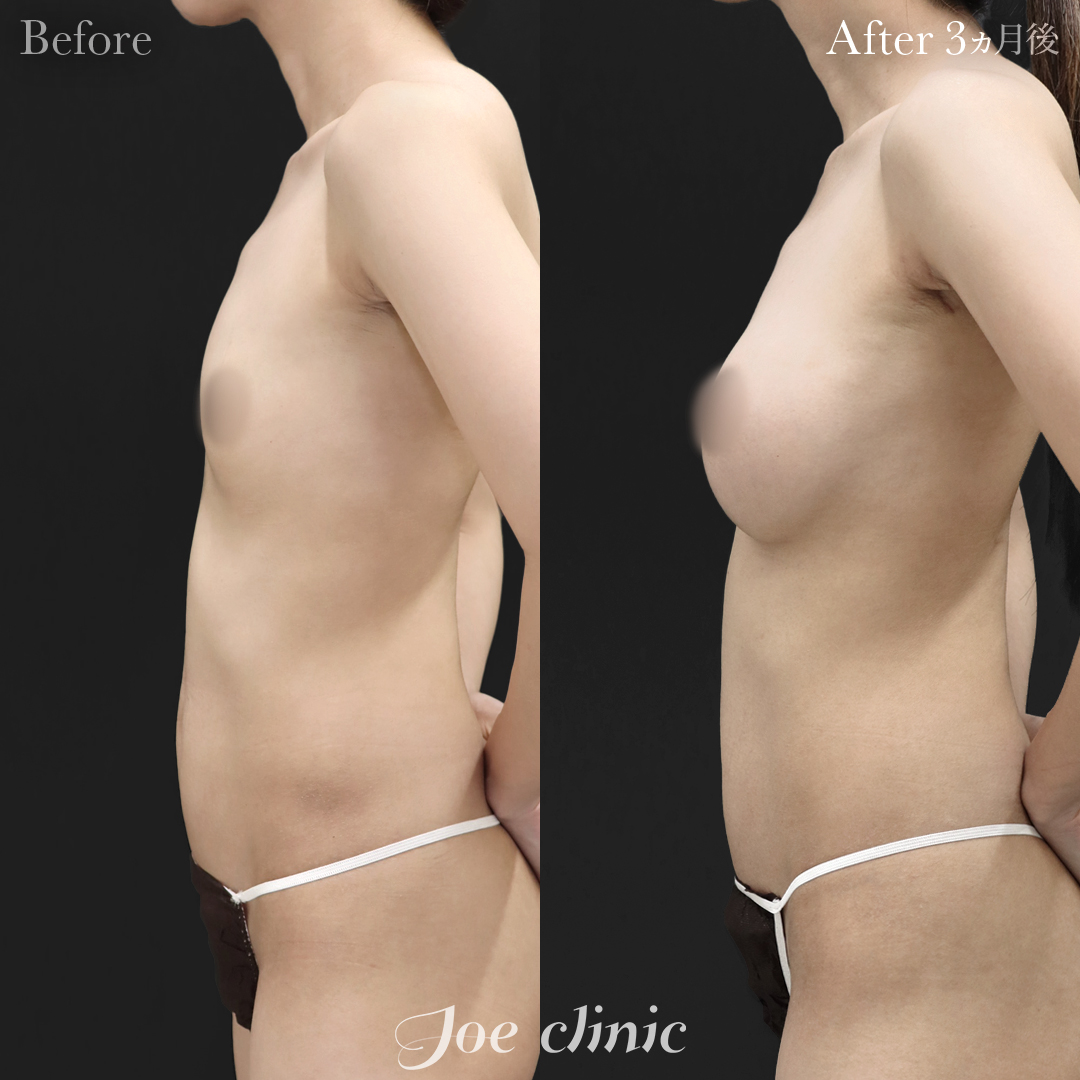 【30代女性】ハイブリッド豊胸(シリコンバッグ豊胸+脂肪幹細胞注入豊胸)|3ヵ月後