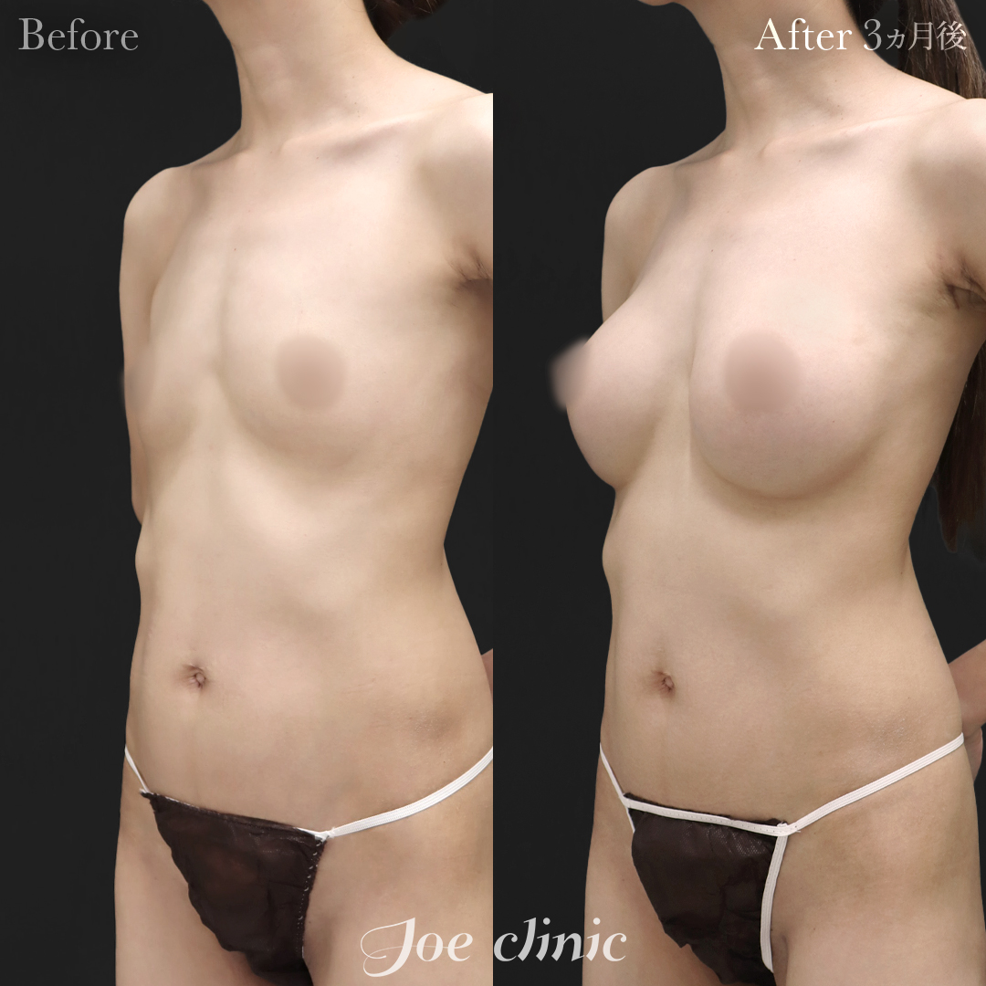【30代女性】ハイブリッド豊胸(シリコンバッグ豊胸+脂肪幹細胞注入豊胸)|3ヵ月後