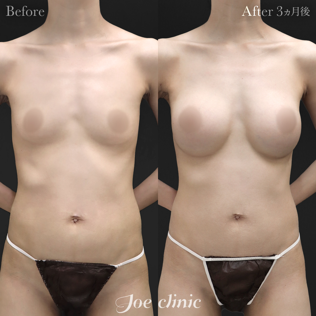 【30代女性】ハイブリッド豊胸(シリコンバッグ豊胸+脂肪幹細胞注入豊胸)|3ヵ月後