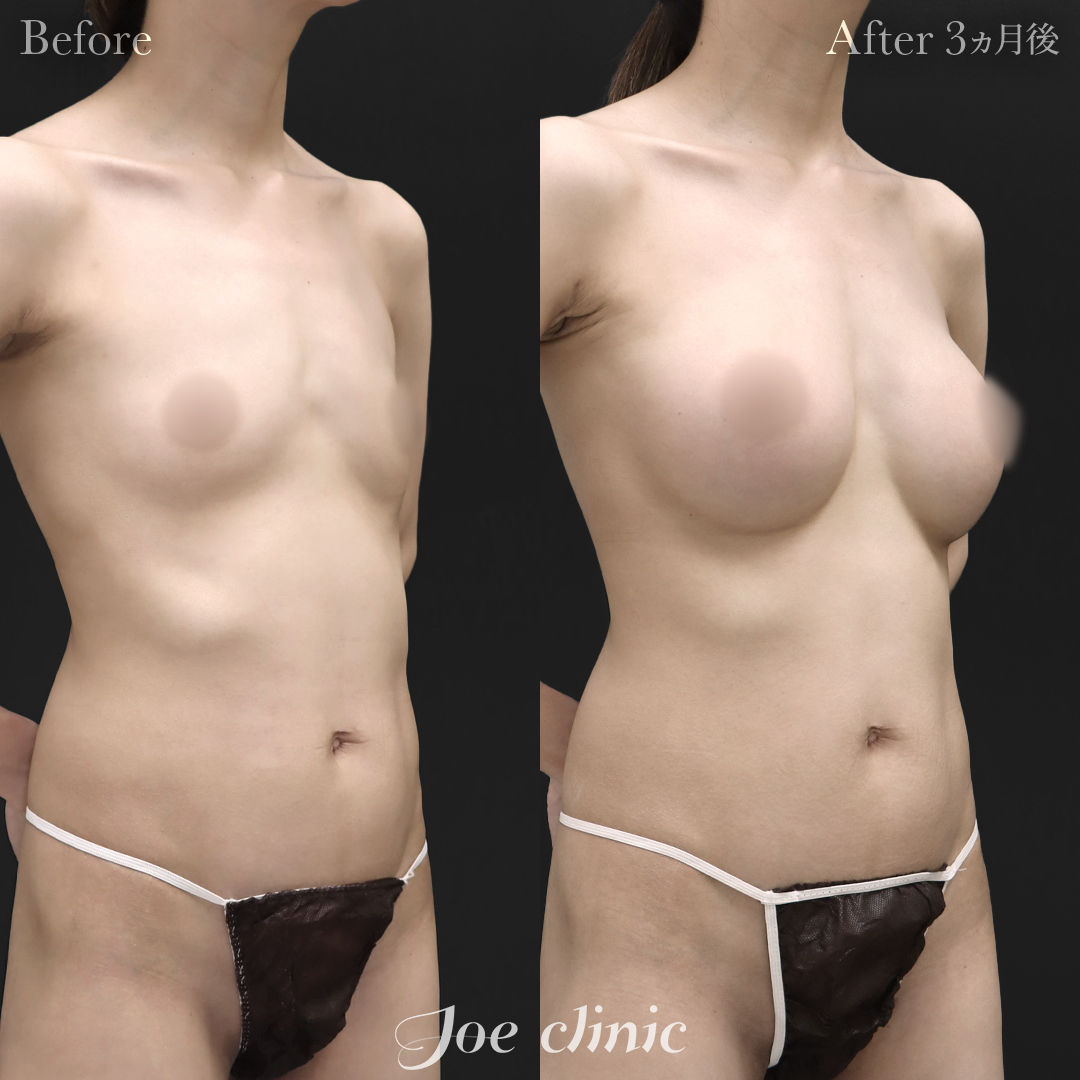 【30代女性】ハイブリッド豊胸(シリコンバッグ豊胸+脂肪幹細胞注入豊胸)|3ヵ月後
