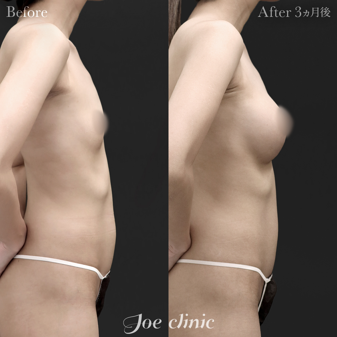 【30代女性】ハイブリッド豊胸(シリコンバッグ豊胸+脂肪幹細胞注入豊胸)|3ヵ月後