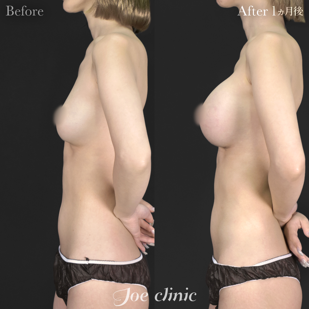 【30代女性】シリコンバッグ豊胸モティバ2(380cc×左右)|1ヵ月後