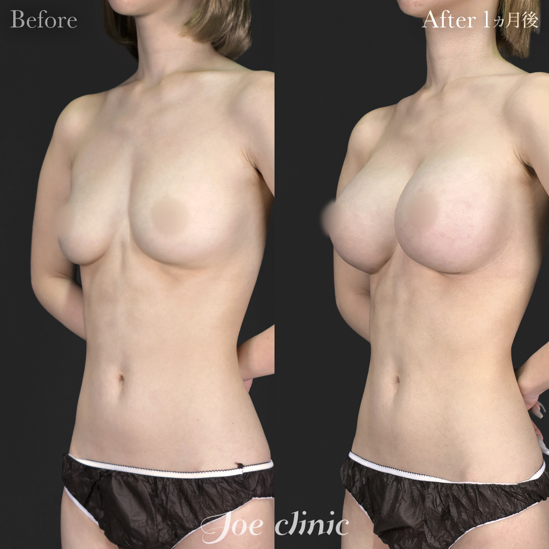 【30代女性】シリコンバッグ豊胸モティバ2(380cc×左右)|1ヵ月後