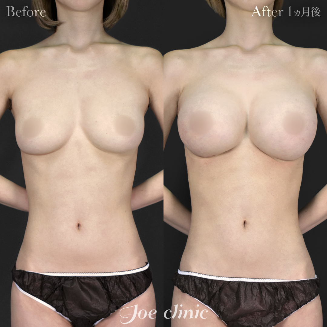 【30代女性】シリコンバッグ豊胸モティバ2(380cc×左右)|1ヵ月後