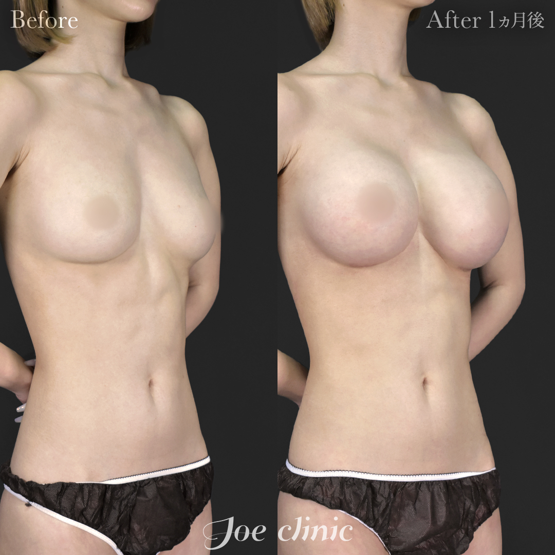 【30代女性】シリコンバッグ豊胸モティバ2(380cc×左右)|1ヵ月後