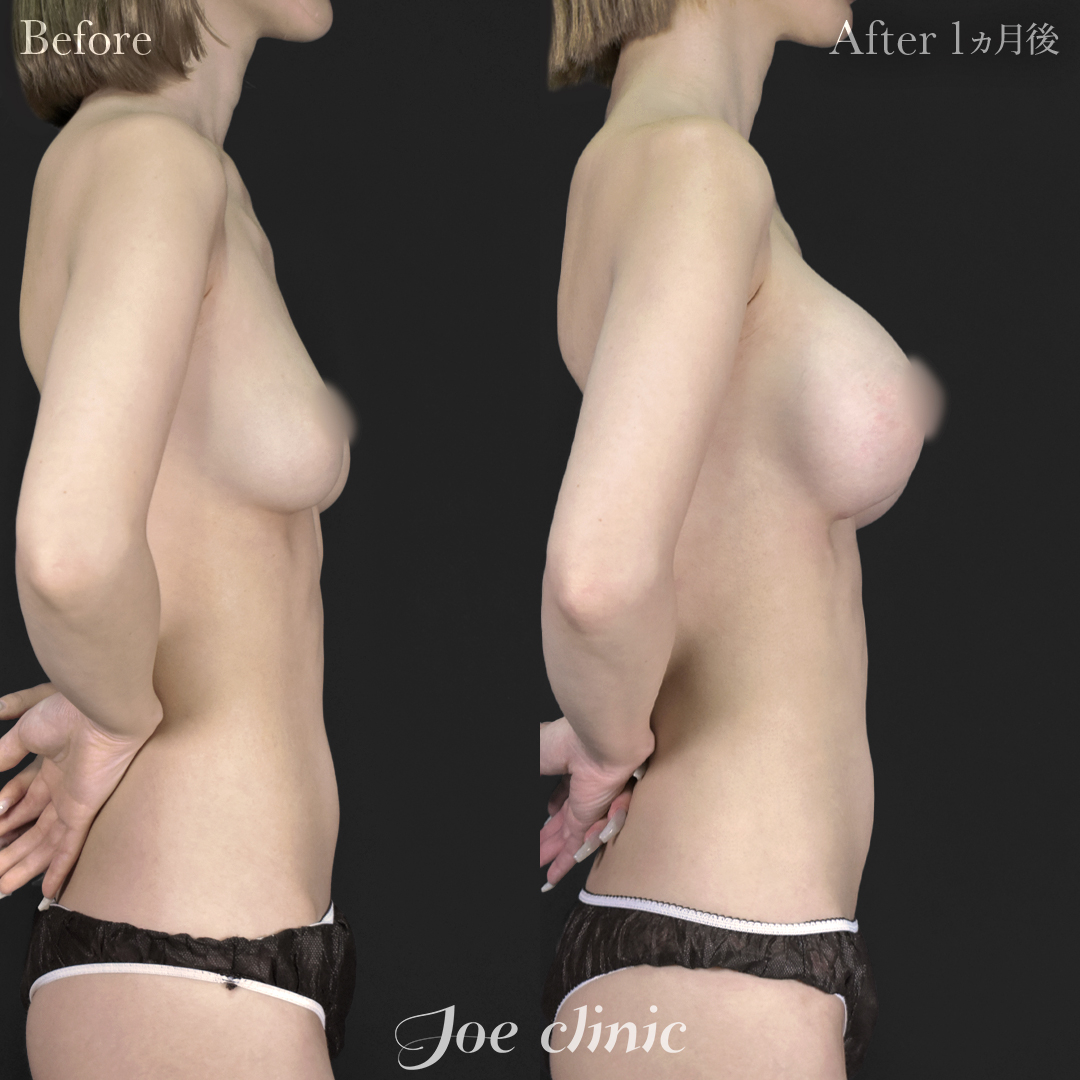 【30代女性】シリコンバッグ豊胸モティバ2(380cc×左右)|1ヵ月後