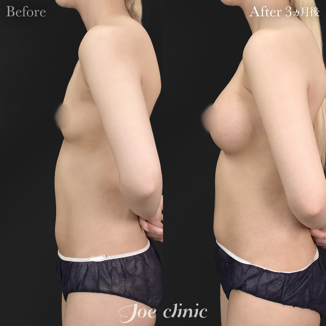 【20代女性】シリコンバッグ豊胸モティバ2(360cc×左右)|3ヵ月後