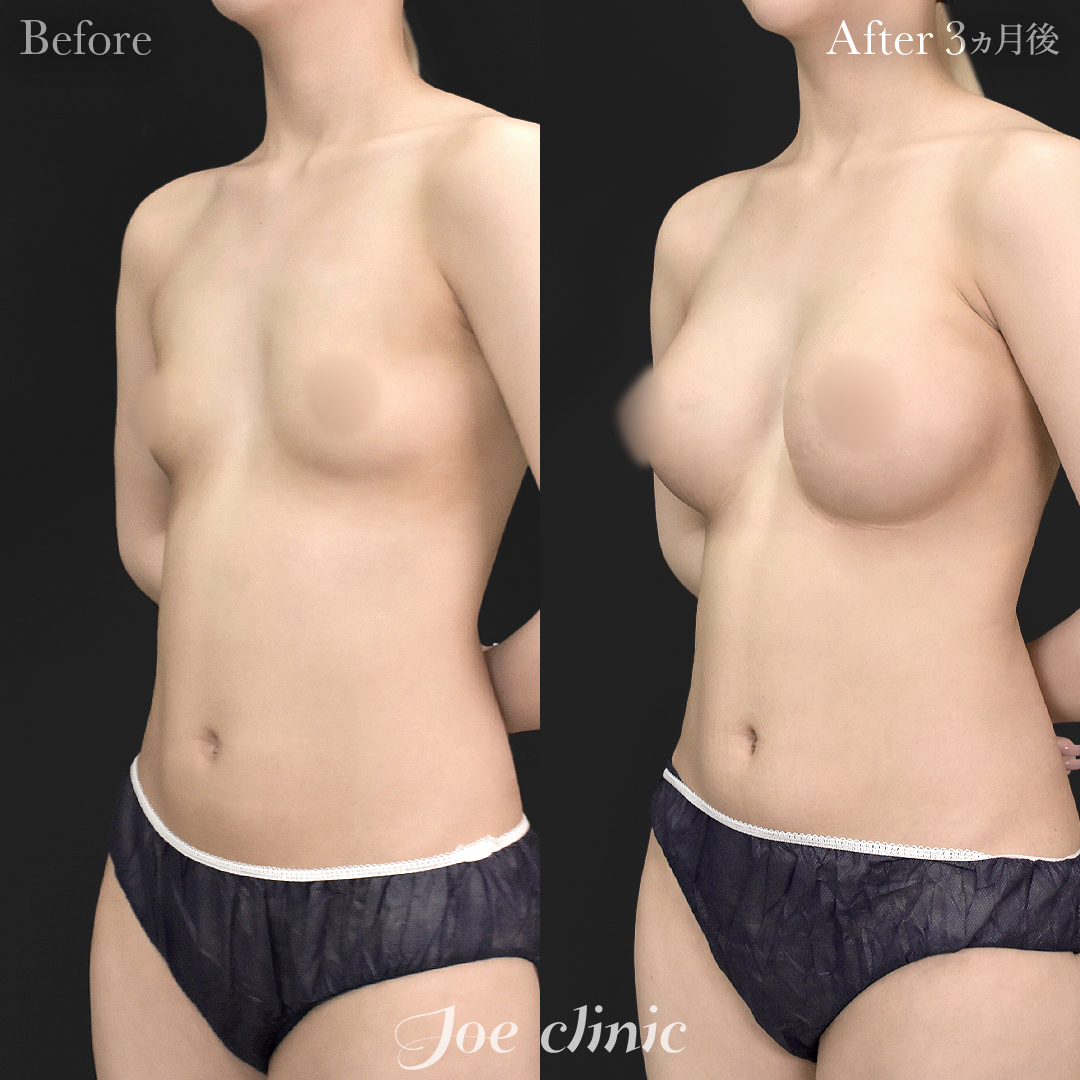 【20代女性】シリコンバッグ豊胸モティバ2(360cc×左右)|3ヵ月後