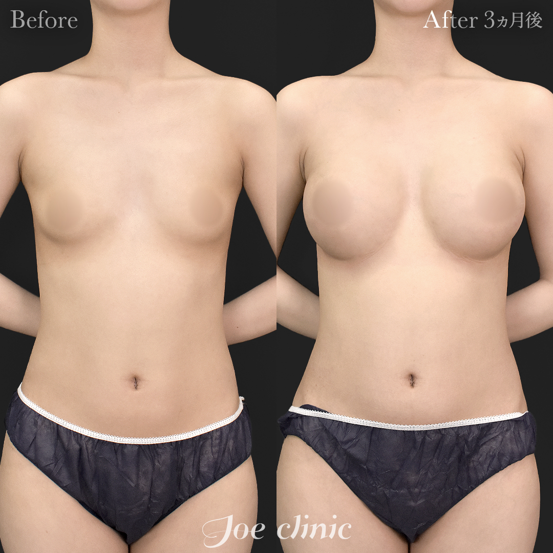 【20代女性】シリコンバッグ豊胸モティバ2(360cc×左右)|3ヵ月後