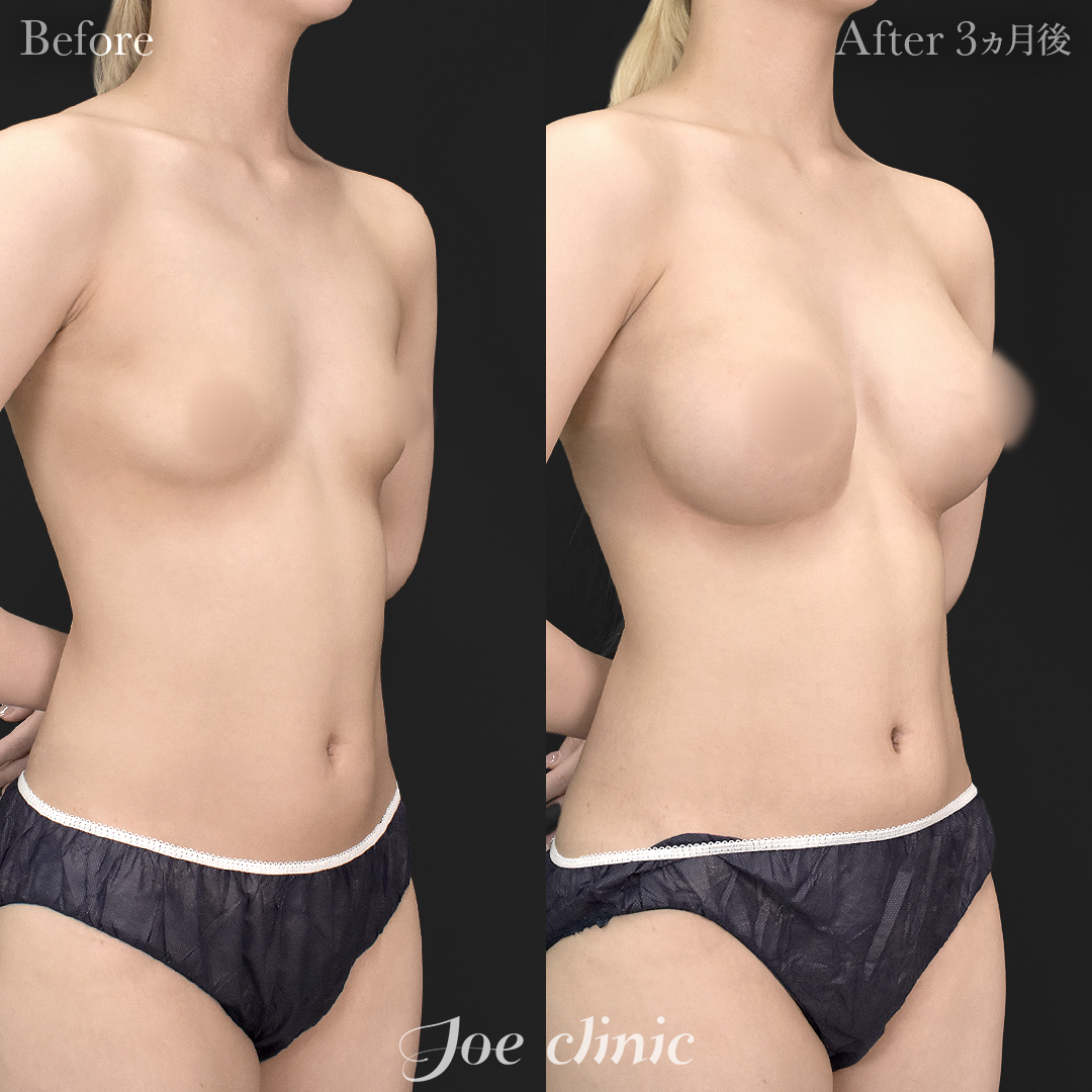 【20代女性】シリコンバッグ豊胸モティバ2(360cc×左右)|3ヵ月後