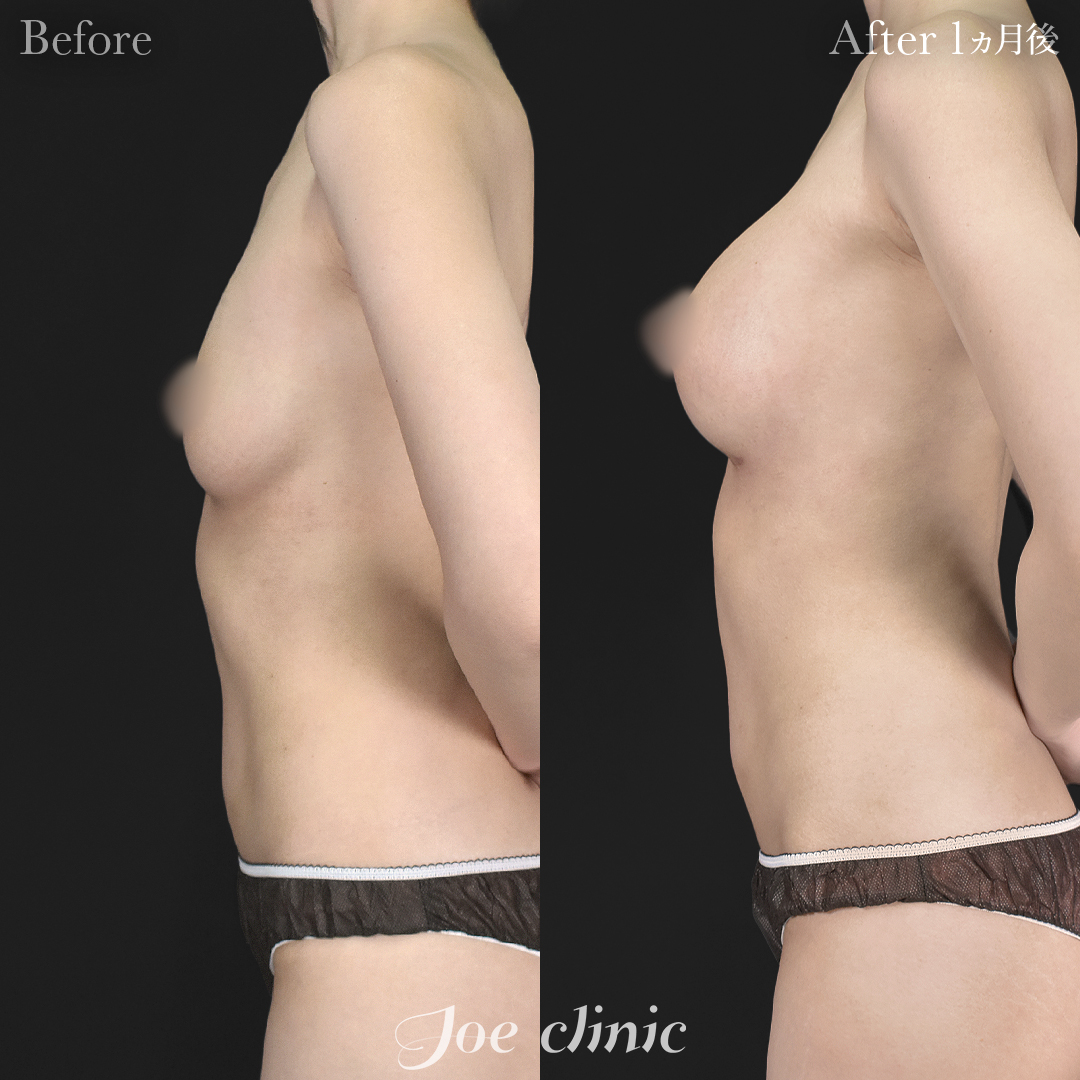 【30代女性】シリコンバッグ豊胸モティバ2(275cc×左右)|1ヵ月後