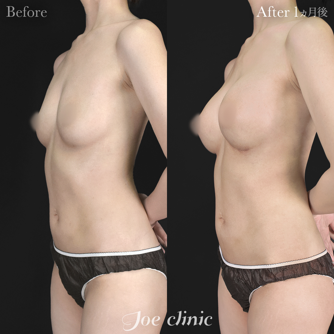 【30代女性】シリコンバッグ豊胸モティバ2(275cc×左右)|1ヵ月後