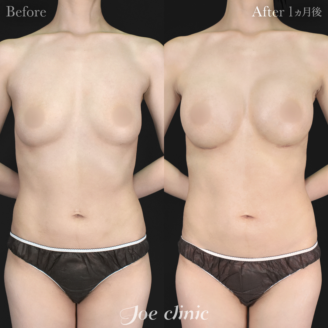 【30代女性】シリコンバッグ豊胸モティバ2(275cc×左右)|1ヵ月後