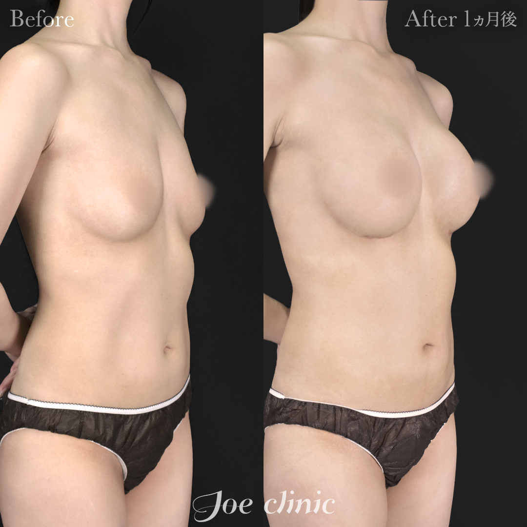 【30代女性】シリコンバッグ豊胸モティバ2(275cc×左右)|1ヵ月後