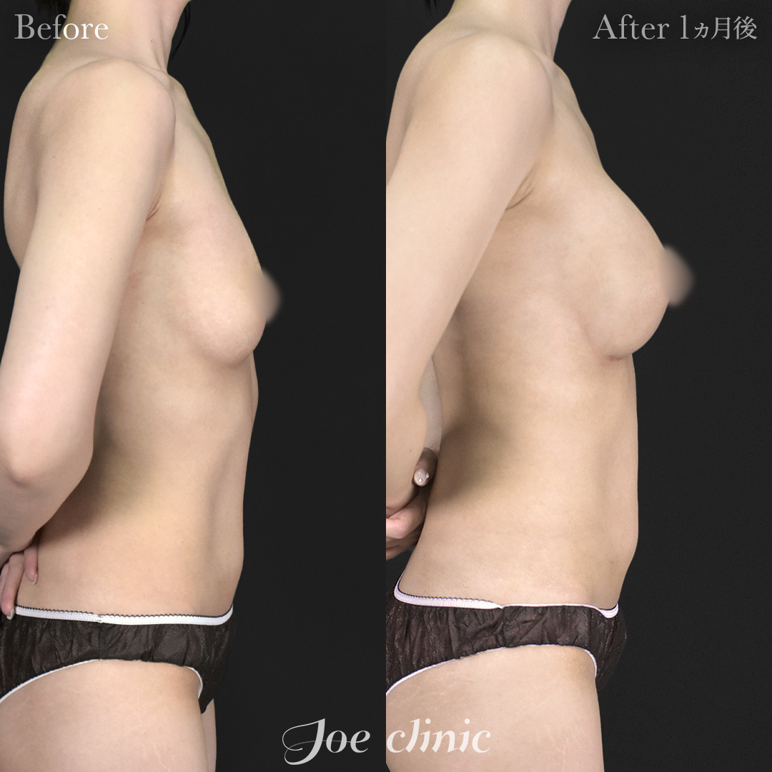 【30代女性】シリコンバッグ豊胸モティバ2(275cc×左右)|1ヵ月後