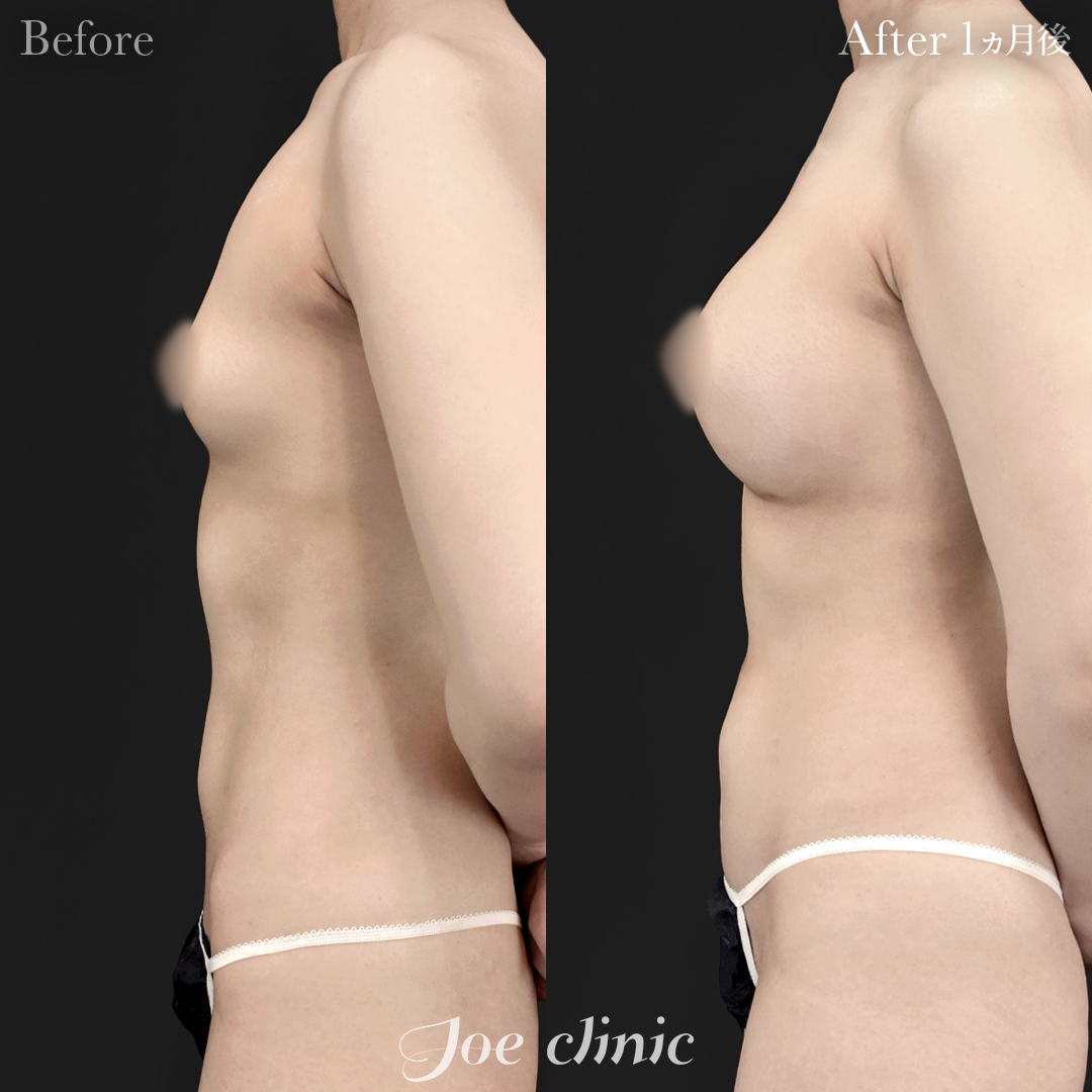 【10代女性】シリコンバッグ豊胸モティバ2(360cc×左右)|1ヵ月後