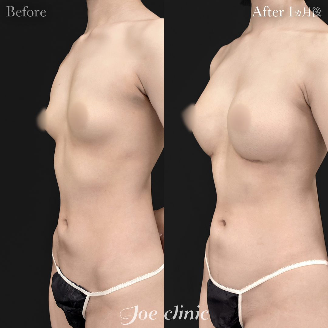 【10代女性】シリコンバッグ豊胸モティバ2(360cc×左右)|1ヵ月後