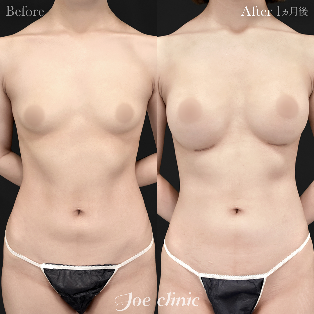 【10代女性】シリコンバッグ豊胸モティバ2(360cc×左右)|1ヵ月後