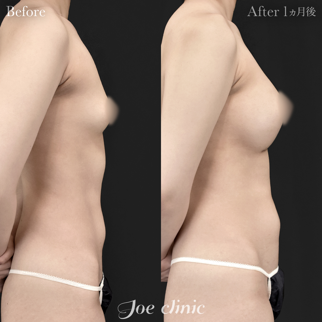 【10代女性】シリコンバッグ豊胸モティバ2(360cc×左右)|1ヵ月後