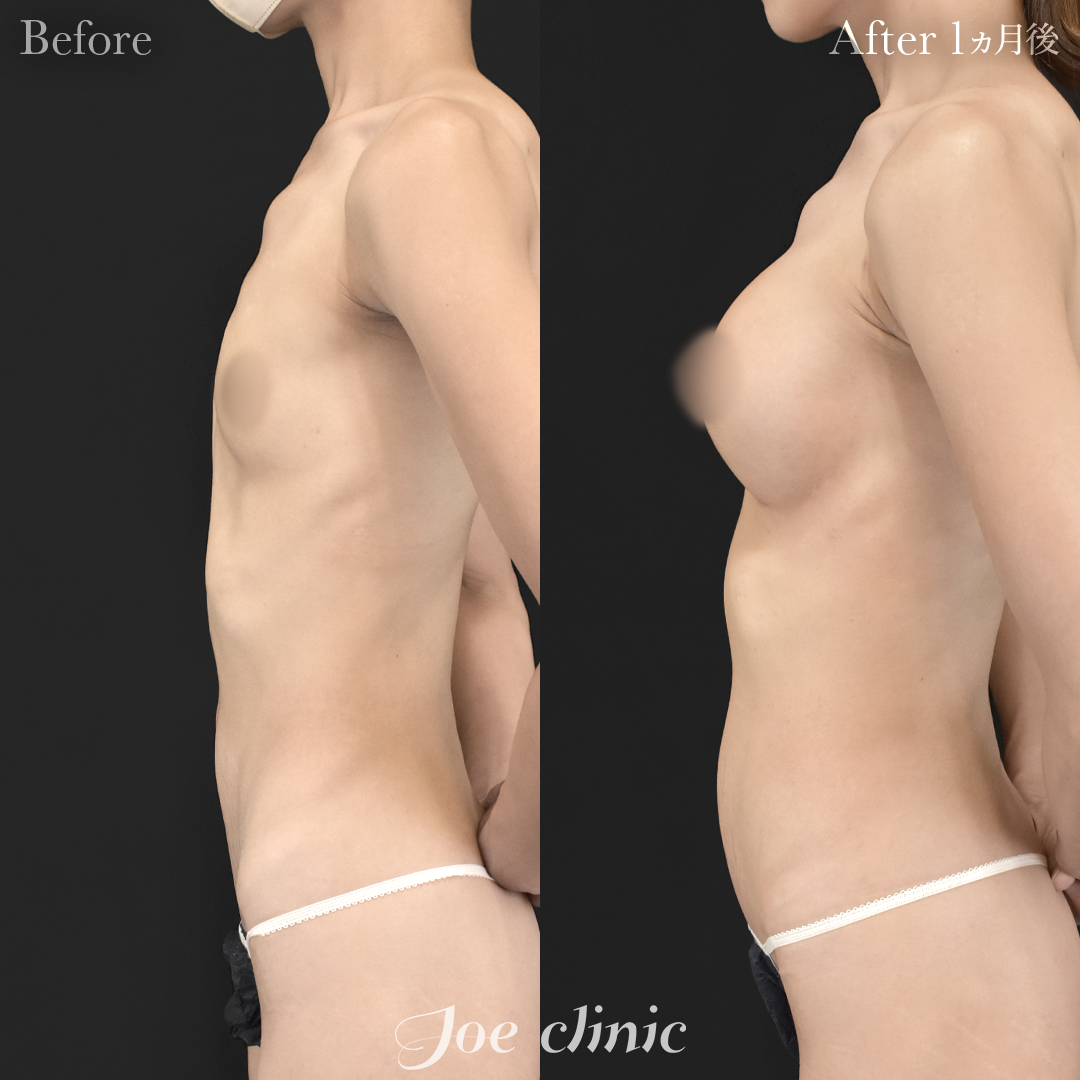 【40代女性】ハイブリッド豊胸(シリコンバッグ豊胸+脂肪幹細胞注入豊胸)|1ヵ月後
